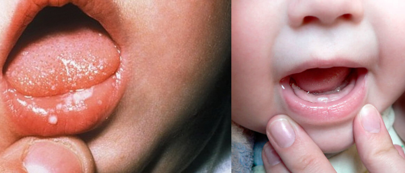 Лечение стоматита во рту у взрослых и детей