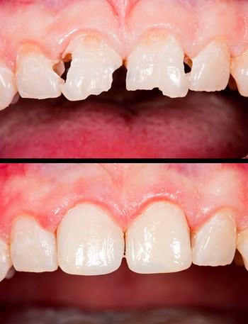 Имплантация зубов - фото 1