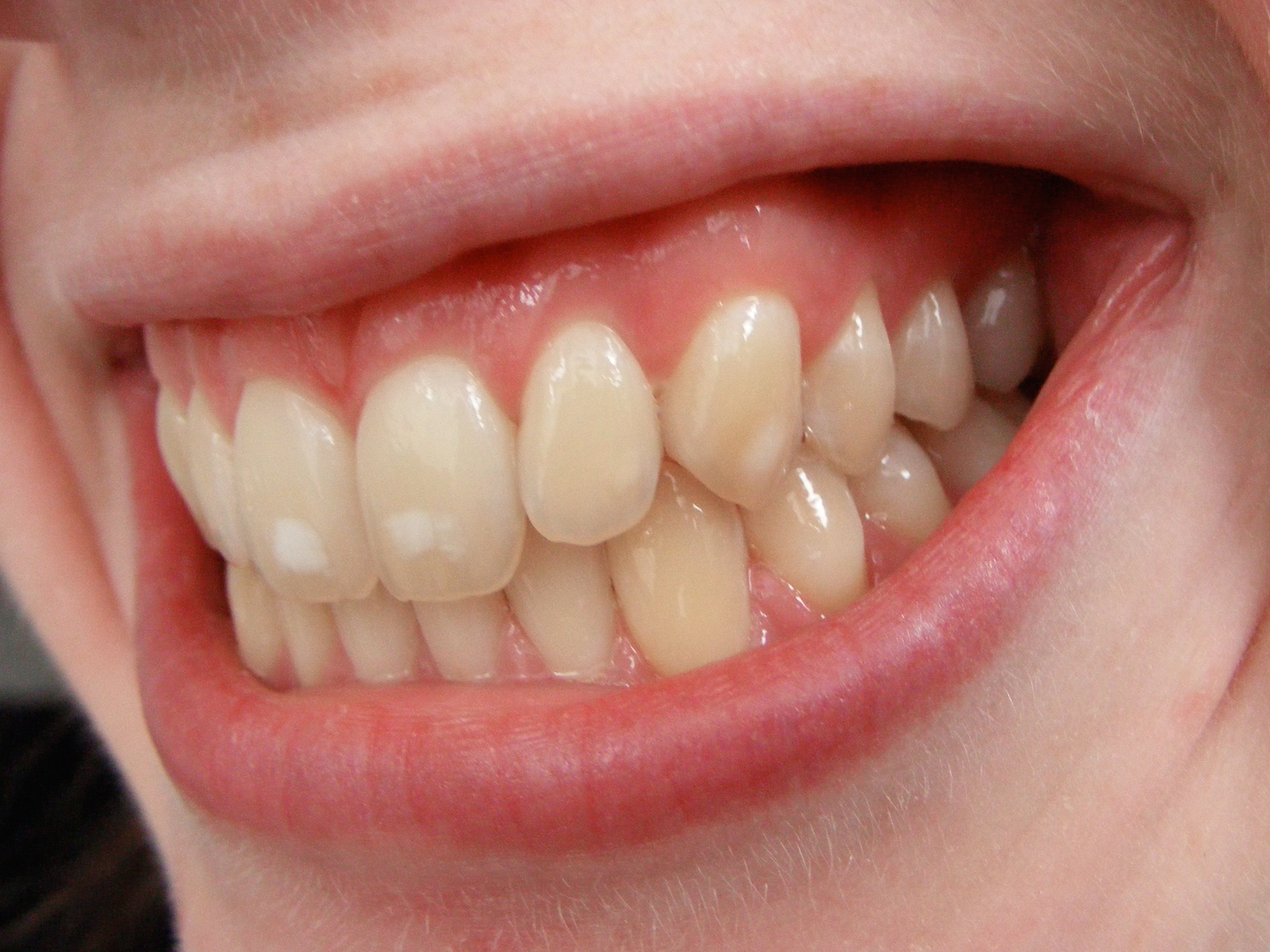 Зубов причины. Меловидно крапчатый флюороз. Тетрациклиновые зубы отбеливание.
