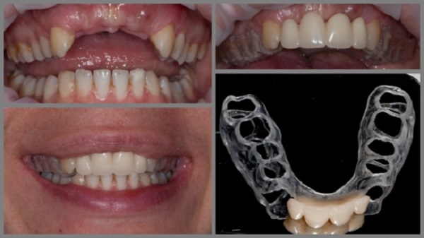 Акриловые зубные протезы: характеристики, преимущества