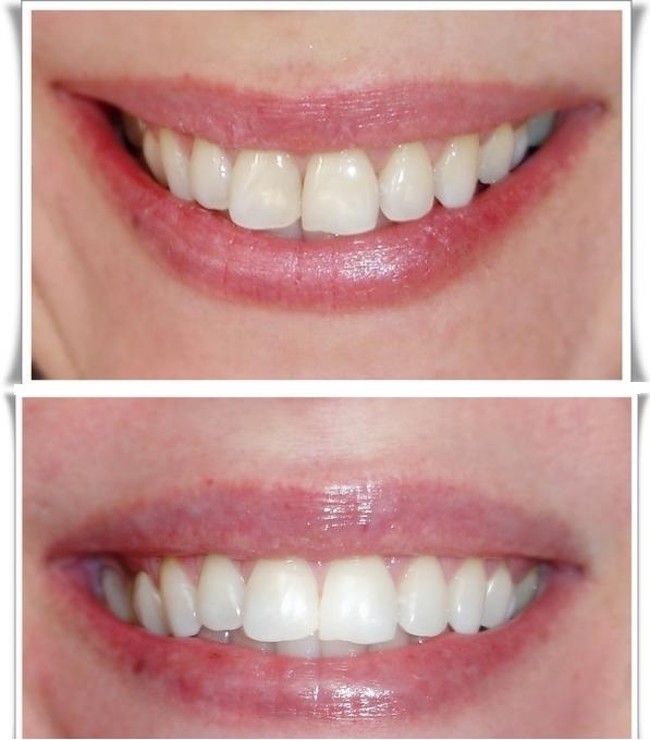 фото зубы до и после отбеливания зубов