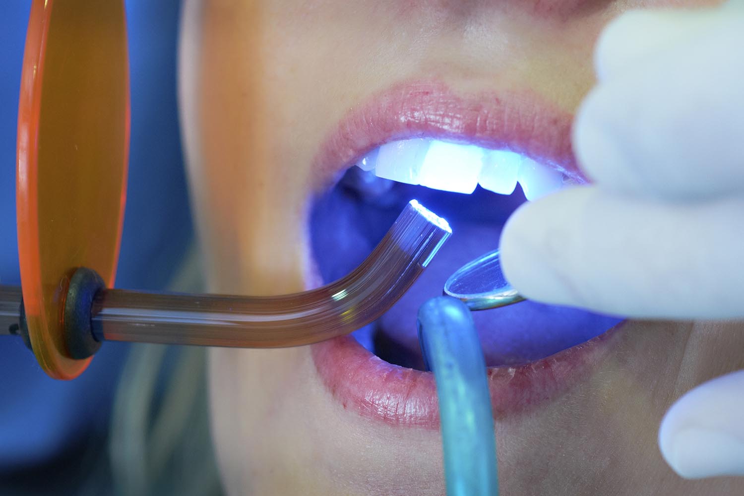 Световая пломба | Состав, сколько стоит | Клиника семейной стоматологии .