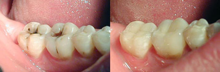 Чувствительность зубов лечение сколько стоит