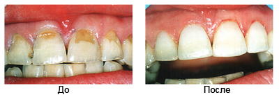 Чувствительность зубов лечение сколько стоит