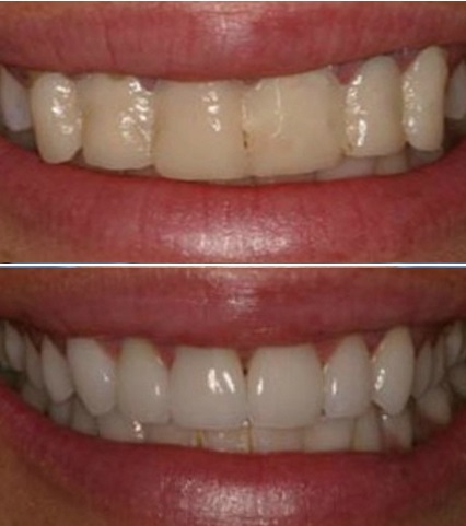 Покрытие фтором. Деминерализации зубов. Фторлак для зубов до и после.
