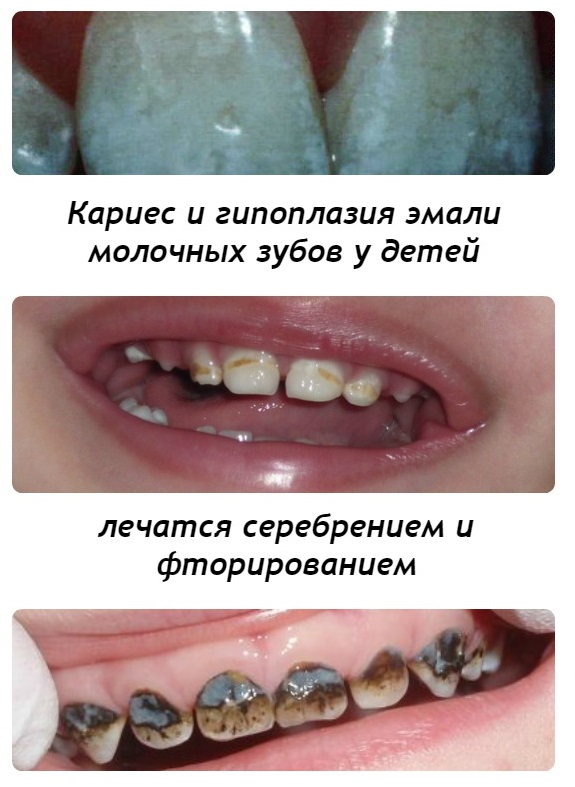 Серебрение молочных зубов Томск Дальне-Ключевская