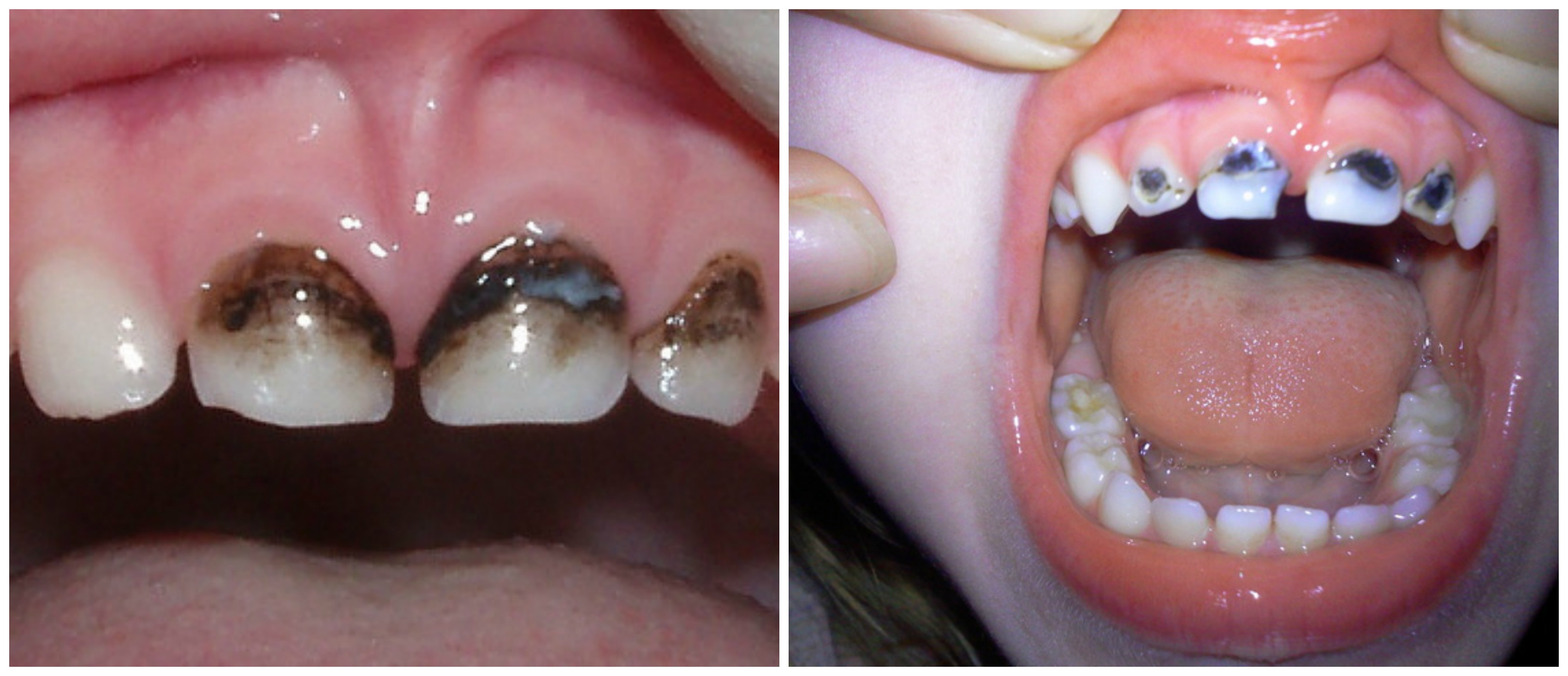 Серебрение молочных зубов Томск Пригородная детские стоматологии в г томск