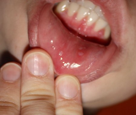 Энтеровирусный везикулярный стоматит (Синдром рука–нога–рот)